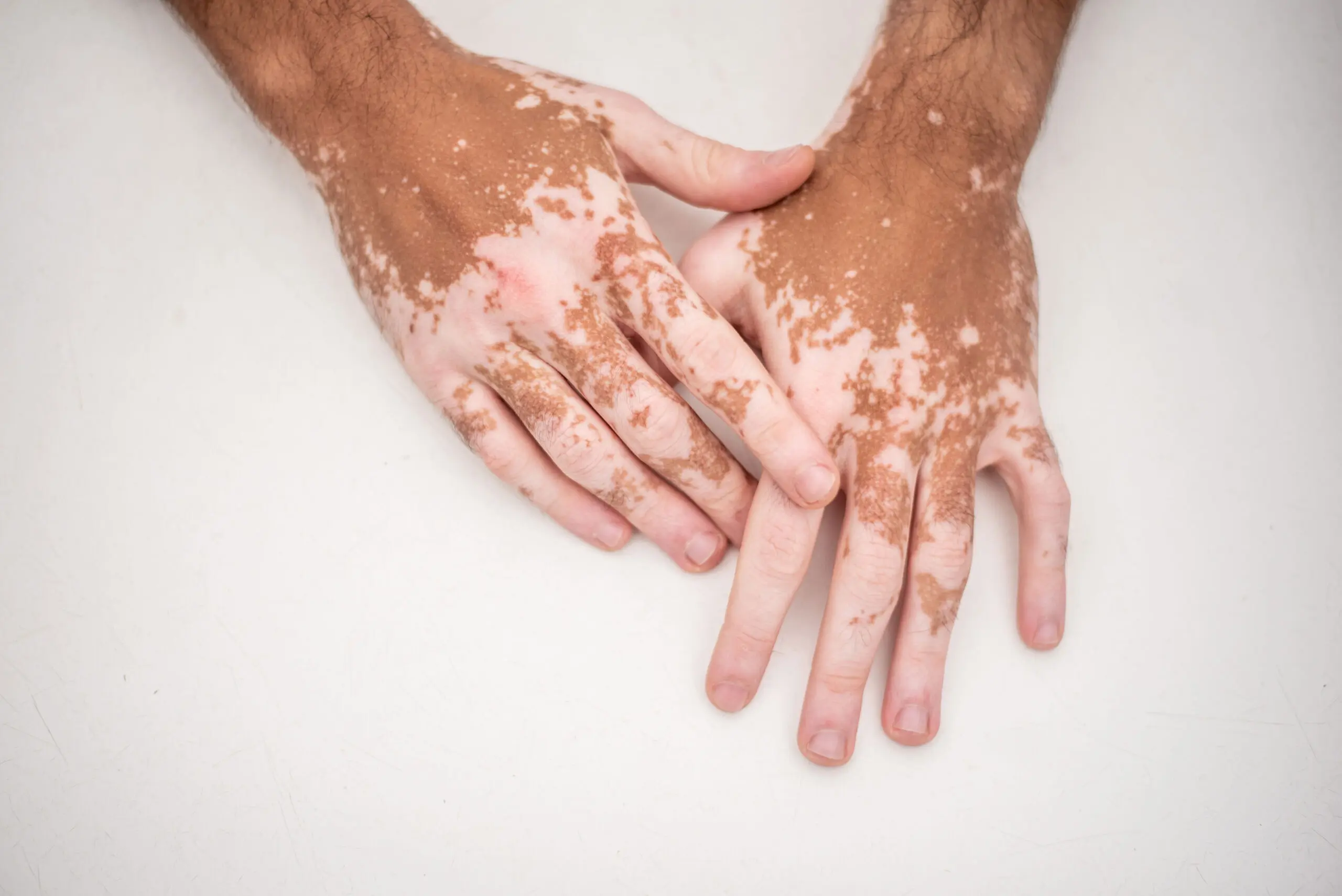A close-up of two hands with vitiligo, emphasizing the diverse range of skin conditions and the importance of accessible dermatological care for all.