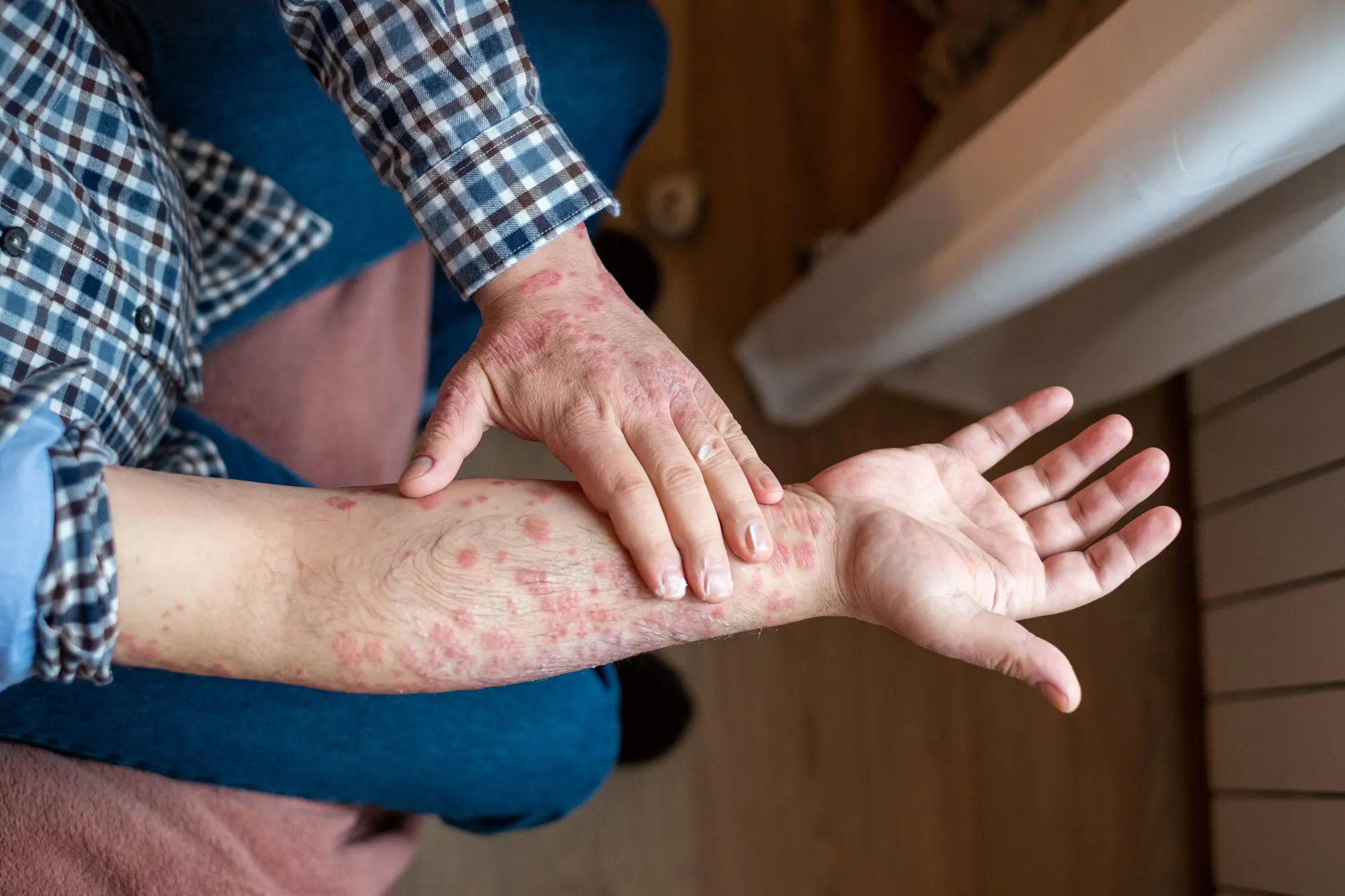 A close-up of a person's forearm with a visible skin rash, while a dermatologist's hands gently examine it. This image highlights the need for expert care for skin conditions.